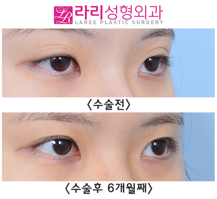 [라리성형외과] 매몰 쌍수가 풀리면 쌍꺼풀 재수술? NoNo 쌍꺼풀 없애기! 관련 이미지 1