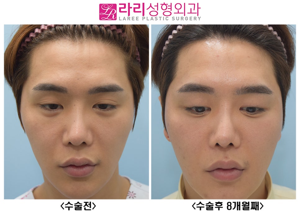 [라리성형외과] 여러겹 두꺼운 자연 쌍꺼풀 무쌍으로 풀기, 없애는 수술 관련 이미지 5