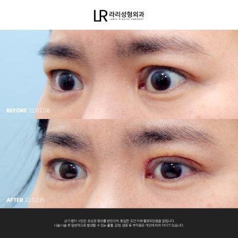 [라리성형외과]  부리부리한 사백안 눈 토안, 이런 눈도 교정 가능할까요 ? 관련 이미지 3
