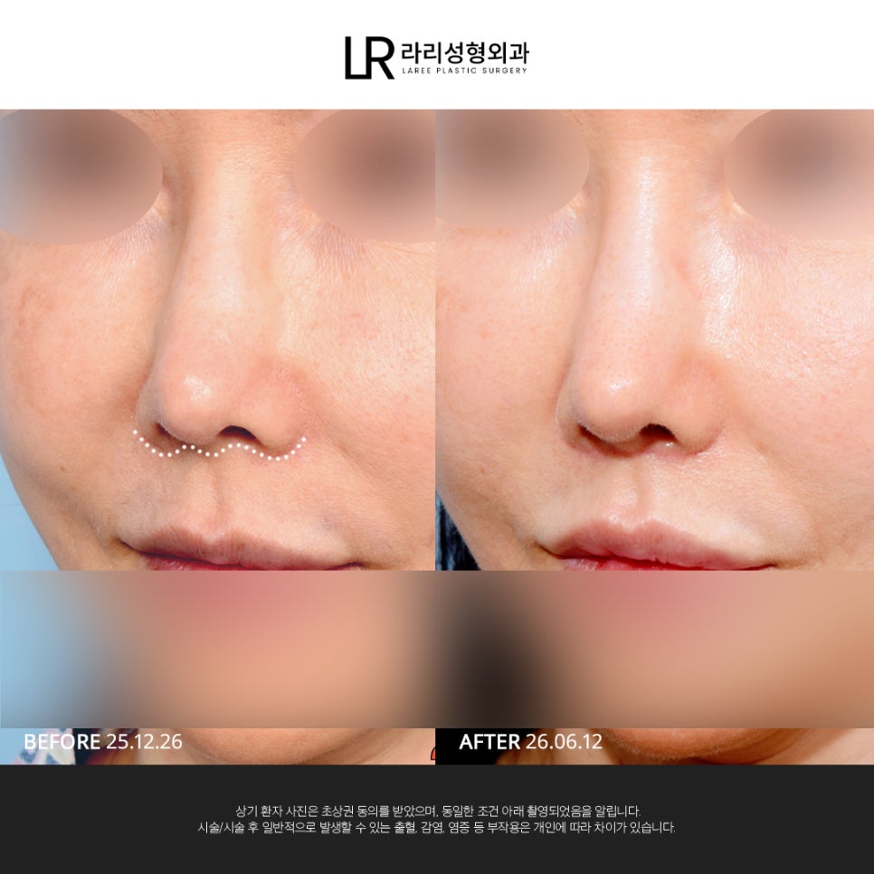 [라리성형외과] 사진 찍으면 유독 길어 보이는 인중, 인중축소로 달라질 수 있을까? 관련 이미지 11
