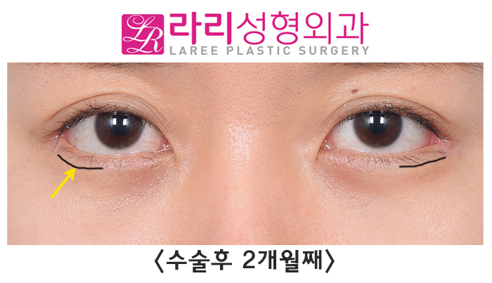 [라리성형외과] 다각도에서 바라보는 비대칭 뒤트임수술 관련 이미지 5