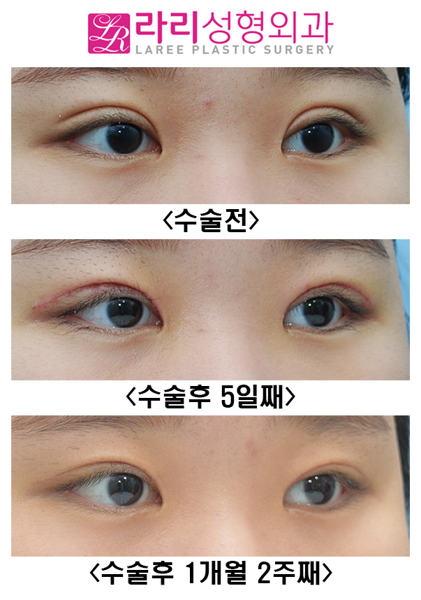 [Lari Plastic Surgery] Revision Double Eyelid Surgery and ROOF Fat Removal image 4