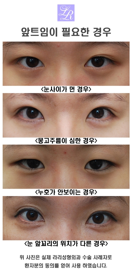 눈앞트임 - 몽고주름제거 얼마나 해야 효과적일까 관련 이미지 3