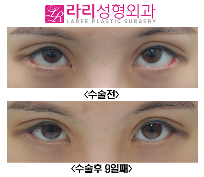 [라리성형외과] 다양한 뒤트임복원수술 전후사진 관련 이미지 4