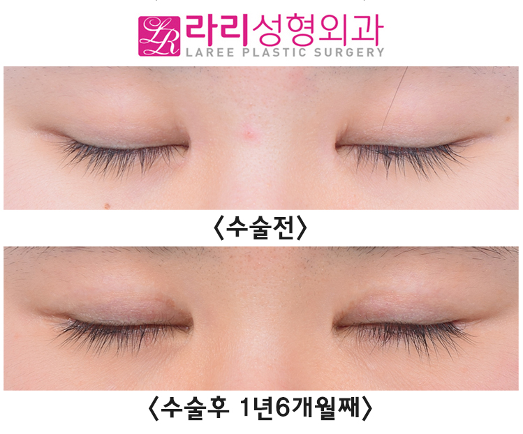 [Rari Plastic Surgery] Comparing the Before-and-After Effects of Lateral Canthoplasty Performed Together with Incisional Double Eyelid Surgery image 4