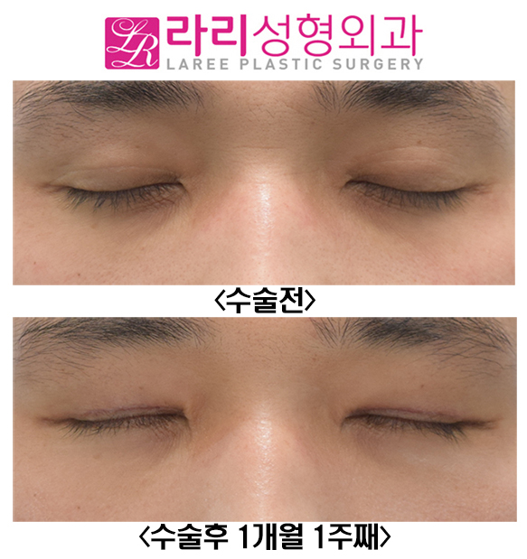 [Lari Plastic Surgery] Before-and-After Photos of Male Ptosis Correction Surgery image 3