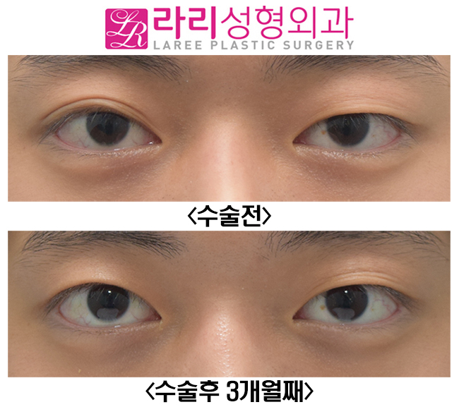 [라리성형외과] 한쪽 쌍수? 한쪽쌍꺼풀없애기? 반대쪽에 쌍꺼풀이 생겨요 관련 이미지 1