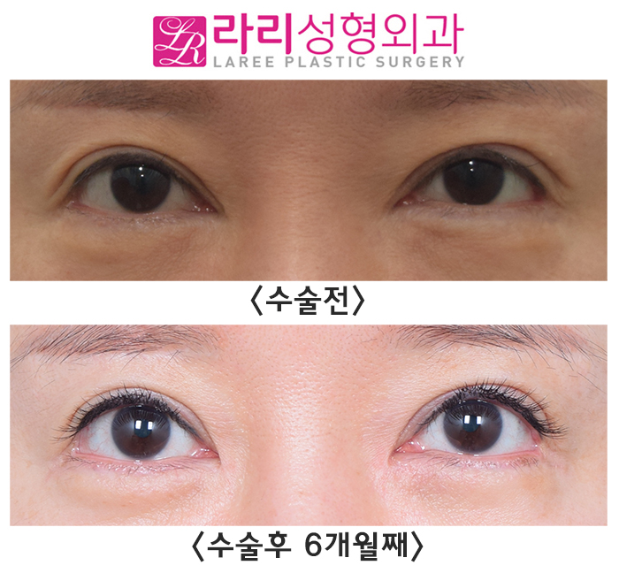 [라리성형외과] 몽고주름을 살리는 앞트임복원 관련 이미지 1