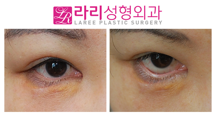[Laree Plastic Surgery] If Ectropion Has Occurred, Let’s Find Out the Right Time for Correction image 1