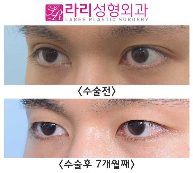 [라리성형외과] 자연쌍꺼풀 ? 쌍수쌍꺼풀 ? 쌍꺼풀없애는수술로 다른 양쪽을 같게 만들어요. 관련 이미지 2