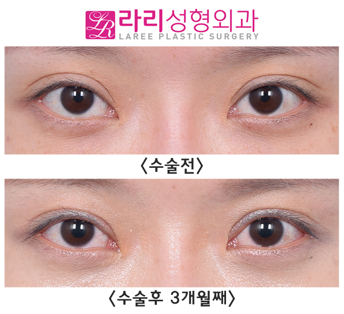 [라리성형외과] 쌍꺼풀재수술로 삼백안이 좋아지는 경우 관련 이미지 2