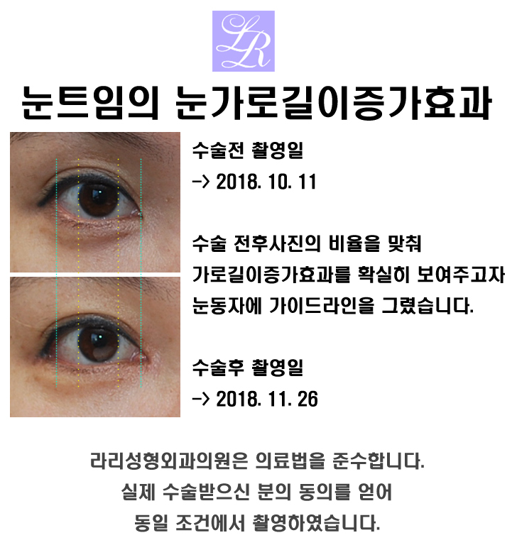 눈 가로길이, 트임 정말 길어질까 관련 이미지 2