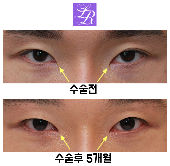Review of Double Eyelid Removal Surgery + Epicanthic Fold Hook Removal Inner Corner Surgery image 2