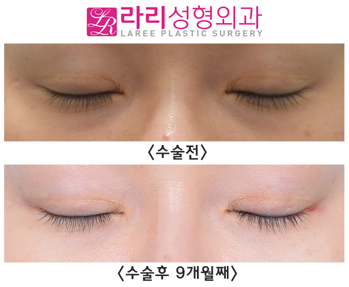 [Lari Plastic Surgery] The first surgery progress for outer corner lowering canthoplasty is good. image 3