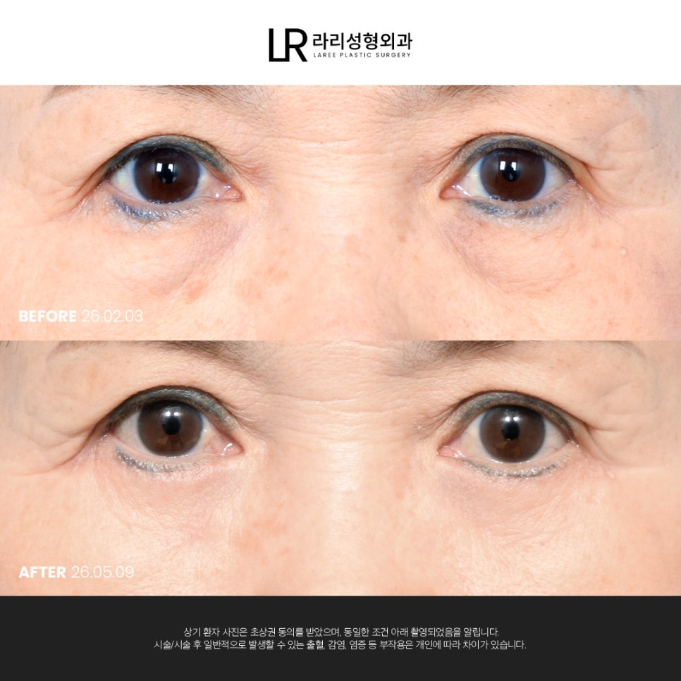 [라리성형외과] 눈 밑이 피곤해 보이는데 눈 밑에 지방만 빼면 될까?(눈밑지방재배치수술 VS 하안검수술) 관련 이미지 1