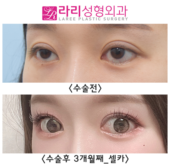 [라리성형외과] 쌍꺼풀재수술, 밑트임복원, 뒤트임재수술 후 다시 태어난 눈 리얼 셀카 후기 관련 이미지 2