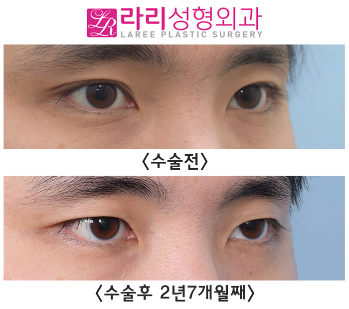 [Lari Plastic Surgery] Long-Term Before-and-After Photos of Surgery to Remove Double Eyelids and Create a Natural Single Eyelid Look image 2