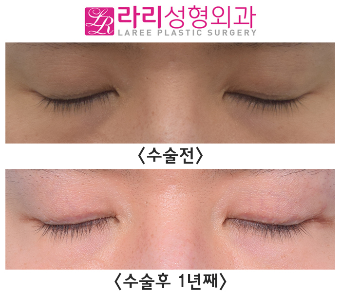 [라리성형외과] 여러 가지 쌍꺼풀 생기는 눈 무쌍으로 바꿔드립니다. 관련 이미지 6