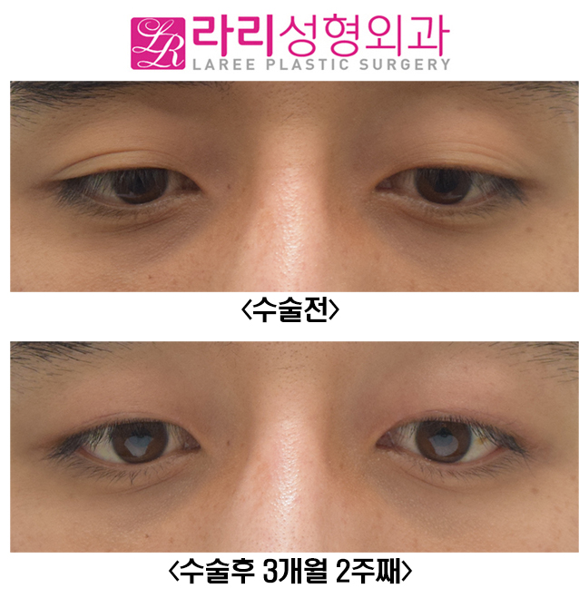 [라리성형외과] 쌍꺼풀 없애는 수술 받으면 쌍꺼풀 없애기 가능한가요..? 관련 이미지 4