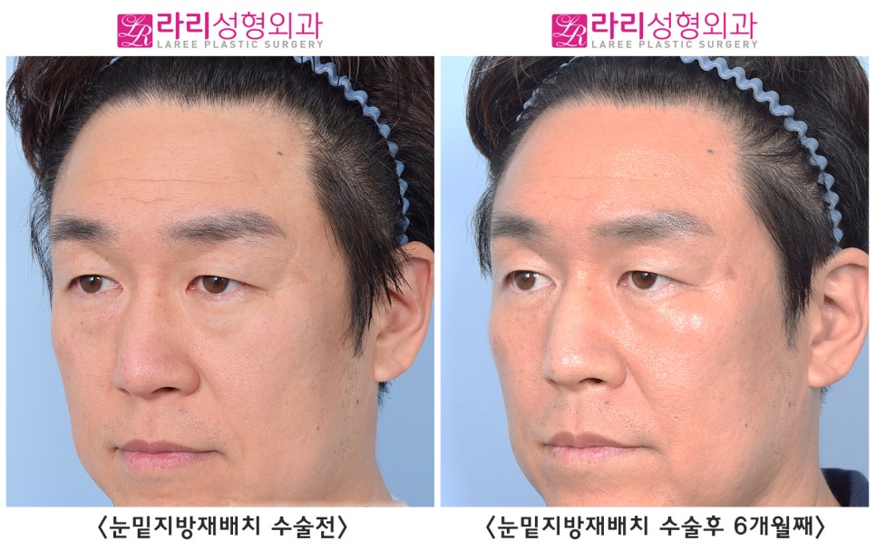 [Rari Plastic Surgery] Differences in Facial Impression Before and After Lower Eyelid Fat Repositioning Surgery in Middle Age image 4