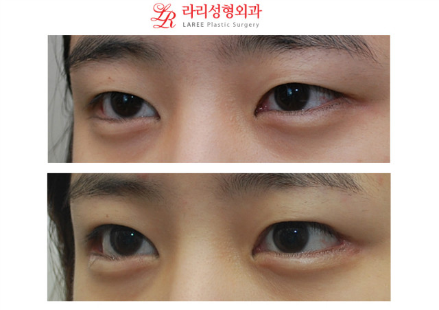 No-line monolid eye correction, downturned outer corner epicanthoplasty revision before-and-after photos image 3
