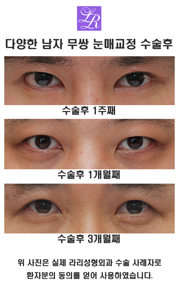 남자눈매교정, 무쌍이 대세 관련 이미지 2