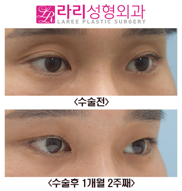 [Lari Plastic Surgery] Sunken Upper Eyelid Fat Grafting + Double Eyelid Removal Before and After Surgery image 3