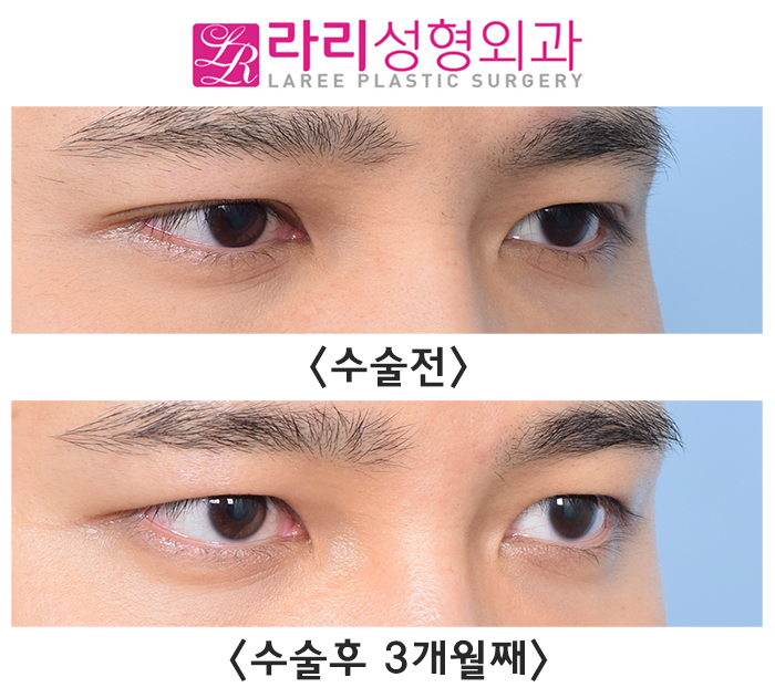 [라리성형외과] 자연쌍꺼풀없애기 수술 전후 사진 회복 기간 짝눈 교정 관련 이미지 1
