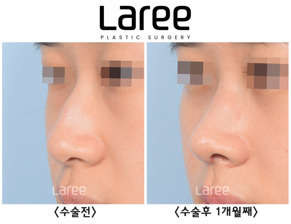 [Lari Plastic Surgery] Hump Nose Surgery Is Performed Naturally Without Implants. (No Implants, Septal Cartilage) image 6