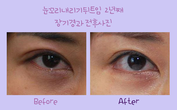 눈꼬리내리기뒤트임/뒷트임 장기경과 후기 효과가 확실하네~☆ 관련 이미지 4