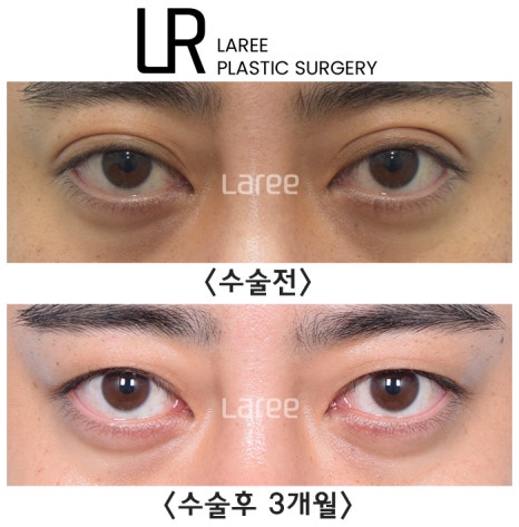 [라리성형외과] 쌍꺼풀없애는 무쌍 수술, 쌍꺼풀라인 낮추기가 아닙니다. (완전무쌍과 무쌍속쌍 그 차이) 관련 이미지 1