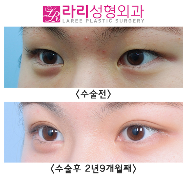 [라리성형외과] 쌍수와 앞트임으로 성숙한 이미지 만들기 관련 이미지 2