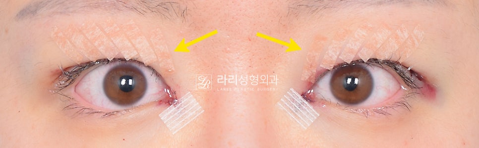 [Lari Plastic Surgery] Removing a Visible Double Eyelid (Double Eyelid Reversal Surgery), From Natural Double Eyelids to Surgical Double Eyelids: A to Z image 21