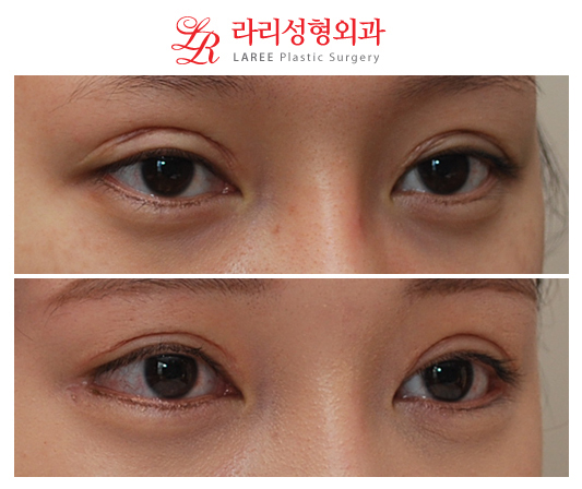 Revision Double Eyelid Surgery, Downward Outer Corner Epicanthoplasty Before and After Photos image 3