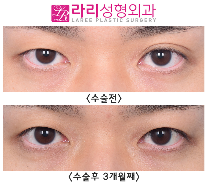 [Lari Plastic Surgery] Removing a Double Eyelid That Formed on Only One Side - Left? Right? Either Is Fine image 1