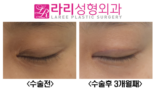 [Lari Plastic Surgery] Cutting Away the Epicanthal Fold: No-Canthus-Opening Surgery Instead of Epicanthoplasty image 3