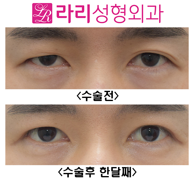 [Larie Plastic Surgery] Surgery to Remove Double Eyelids and Short-Term One-Month Progress Before and After Eye Correction Surgery image 1
