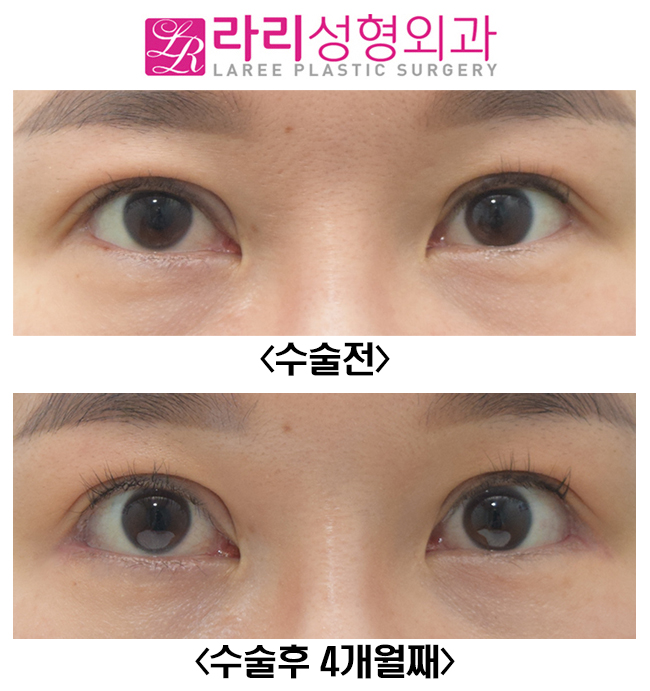 [라리성형외과] 밑트임복원, 뒤트임재수술 전후 사진 관련 이미지 1
