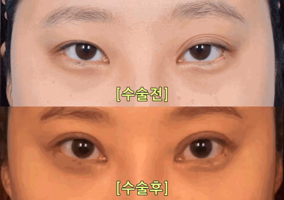 [Laree Plastic Surgery] One-Sided Release After Buried Double Eyelid Surgery, Multiple-Fold Double Eyelid Revision Surgery and Changes After Eyelid Correction image 5