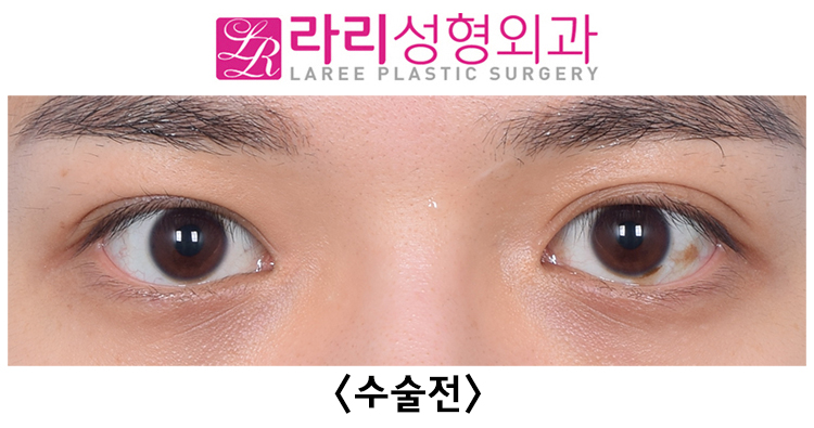 [Lari Plastic Surgery] Correcting Uneven Eyes with Forehead Botox After Double Eyelid Removal Surgery image 1