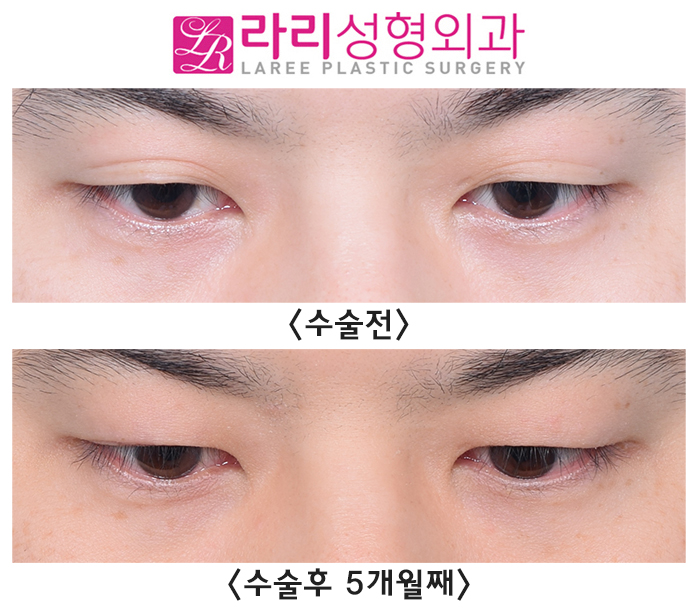 [Lari Plastic Surgery] Completely monolid, removing a natural double eyelid: the eyes close well too. image 4