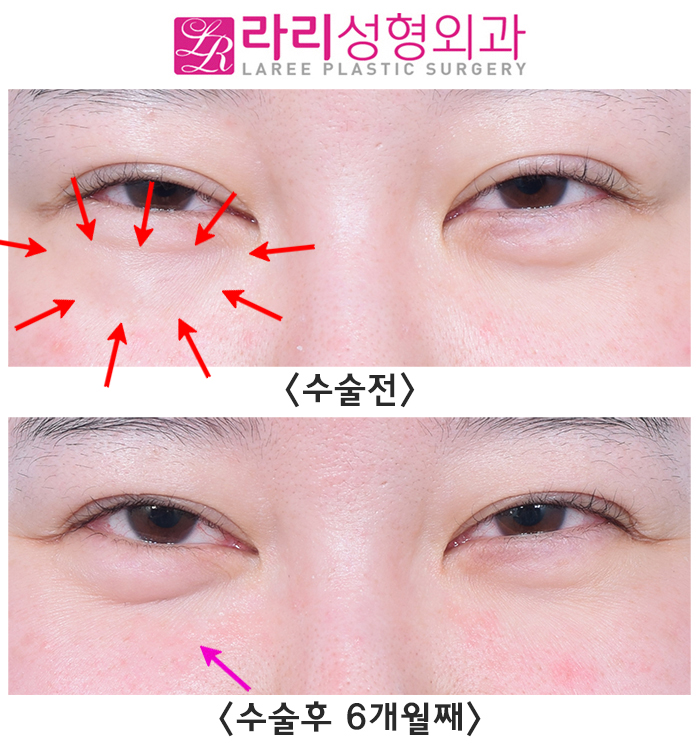[라리성형외과] 눈밑이물질(스컬트라)제거 수술 전후 사진 차이 관련 이미지 3