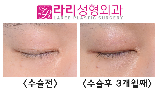 [라리성형외과] 고르지 못한 쌍꺼풀 라인의 개선을 위한 쌍꺼풀 지우는 수술 전후 사진 관련 이미지 2