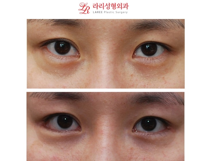 눈꼬리내리기뒤트임,눈밑지방재배치 전후사진 관련 이미지 1