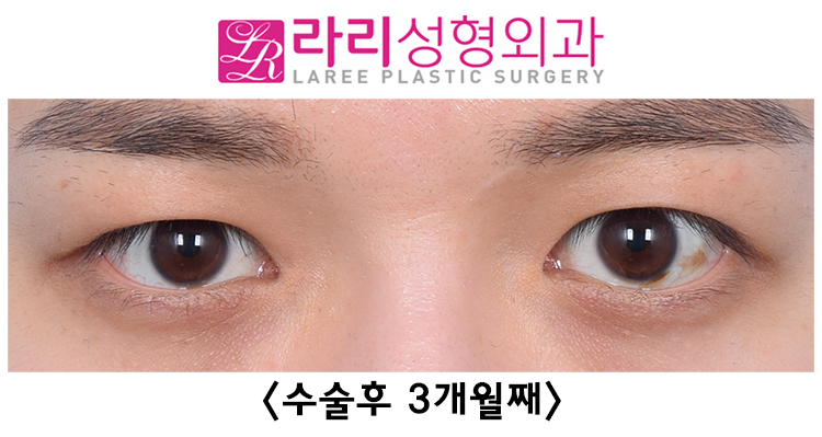[Lari Plastic Surgery] Correcting Uneven Eyes with Forehead Botox After Double Eyelid Removal Surgery image 2