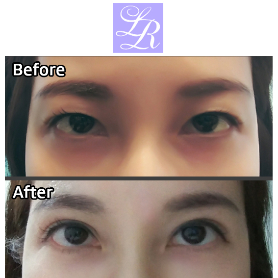 Revision Surgery to Raise the Buried Double Eyelid Line - Will It Change the Eye Shape? image 4
