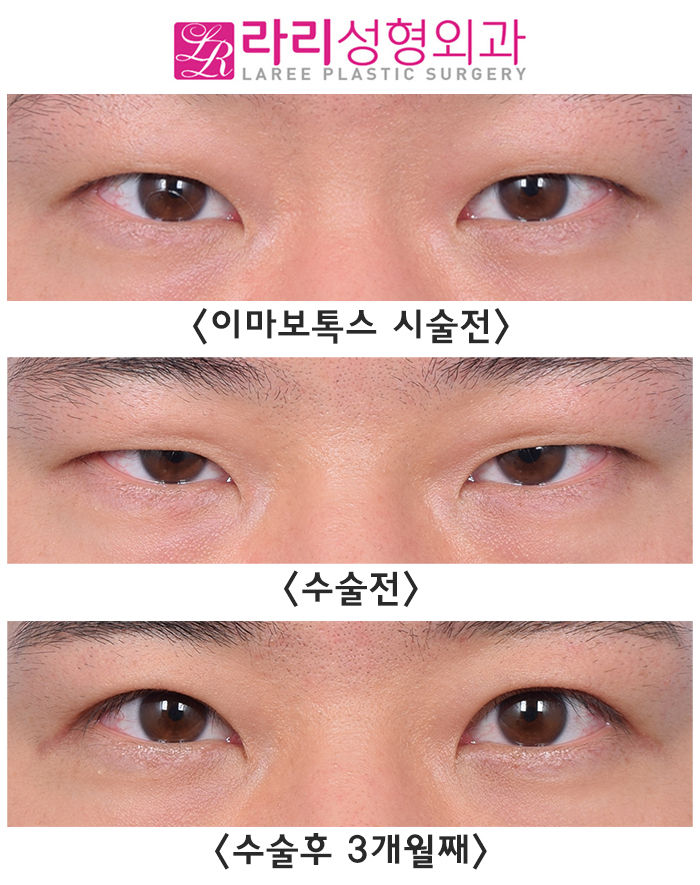 [라리성형외과] 이마미간 보톡스 그리고 절개 눈매교정 수술 전후 사진 단기 경과 관련 이미지 5