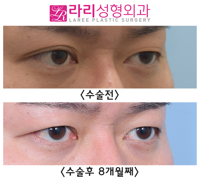 [Lari Plastic Surgery] Double Eyelid Removal Surgery That Completely Removes the Double Eyelid Line image 3