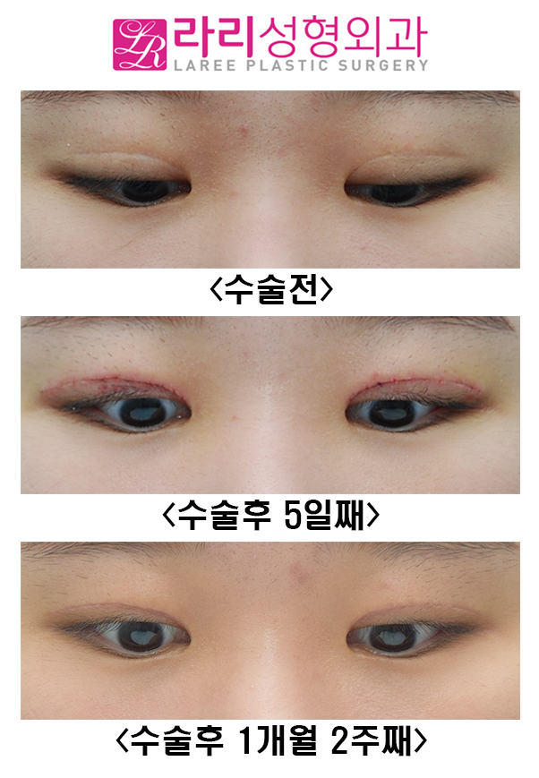 [Lari Plastic Surgery] Revision Double Eyelid Surgery and ROOF Fat Removal image 2