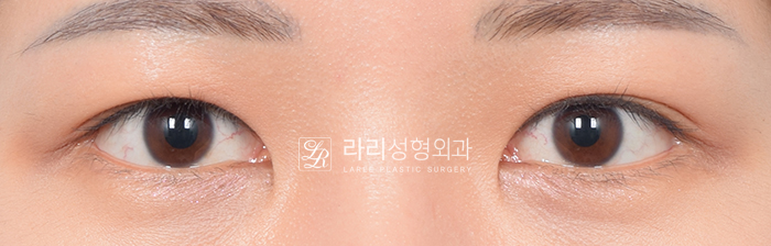 [라리성형외과] 아이홀 꺼짐 있는 눈 파악하고, 윗눈꺼풀 지방이식으로 교정 관련 이미지 6